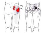 梨状筋におけるトリガーポイント.JPG